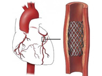 В каких случаях устанавливают стент в сосуд сердца